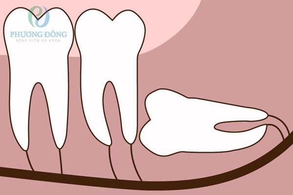 Răng khôn hàm dưới mọc ngầm đâm vào răng bên cạnh