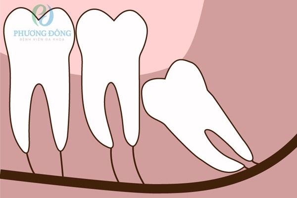 Răng khôn bị lợi trùm dễ gây viêm lợi
