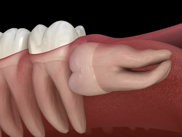 Răng khôn mọc ngang cần phải loại bỏ ngay để tránh ảnh hưởng đến sức khỏe răng miệng