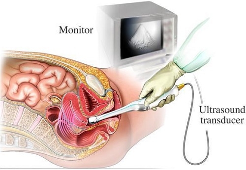 Siêu âm đầu dò không thấy thai: Nguyên nhân, Hậu quả và Giải pháp