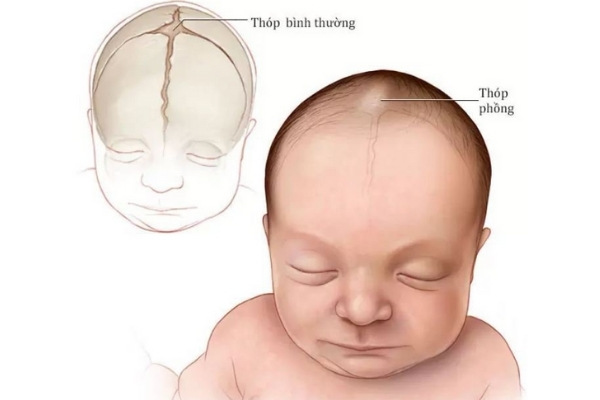 Thóp trẻ sơ sinh phập phồng quá mức là dấu hiệu cảnh báo một số bệnh nguy hiểm