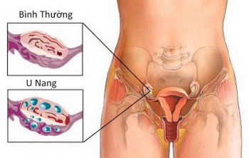 nội mạc tử cung mỏng là gì