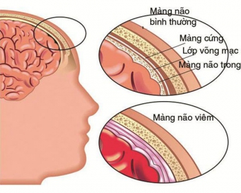 Bệnh viêm não mô cầu: Nguyên nhân gây bệnh và cách nhận biết các dấu hiệu sớm