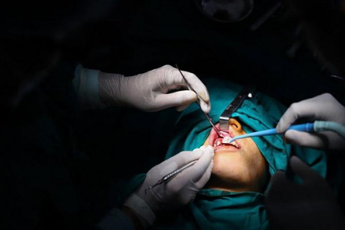 Cấy xương trồng răng Implant  – Phương pháp phục hồi răng tối ưu cho người mất răng và bị tiêu xương hàm