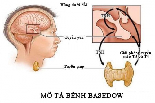 Bệnh basedow: Nguyên nhân, triệu chứng và cách điều trị