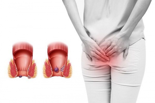 Bệnh trĩ: Những thông tin quan trọng không nên bỏ qua