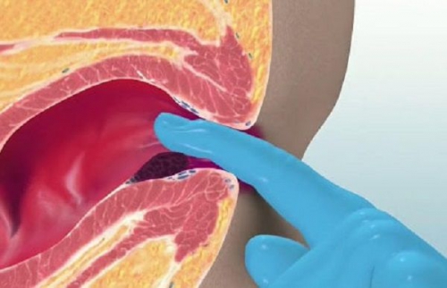 Bệnh trĩ nội và cách điều trị trĩ nội qua từng cấp độ