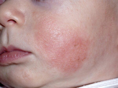Nguyên nhân và cách điều trị viêm da cơ địa ở trẻ sơ sinh