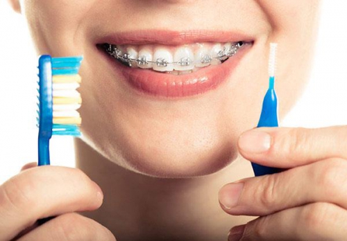 Hướng dẫn cách chăm sóc răng miệng sau khi niềng răng