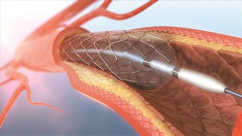 Đặt stent mạch vành là gì? Quy trình thực hiện và những điều cần lưu ý