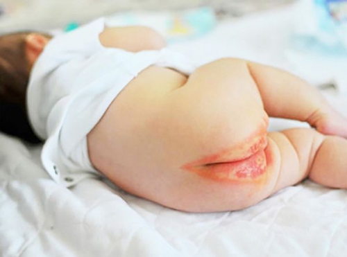 Cách trị hăm cho trẻ sơ sinh tại nhà