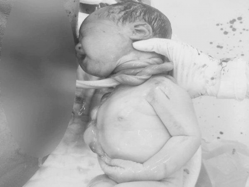 Dây rốn quấn cổ 2 vòng tuần 38 sinh thường được không?