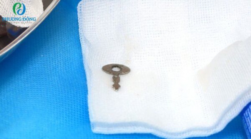 Cấp cứu thành công em bé 3 tuổi nuốt chìa khóa dài 3cm