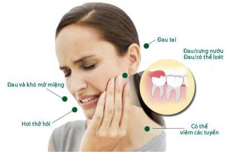 Mọc răng khôn bị đau phải làm sao? Cách giảm đau tại nhà
