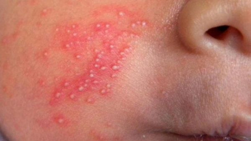 Mụn sữa ở trẻ sơ sinh bao lâu thì hết?
