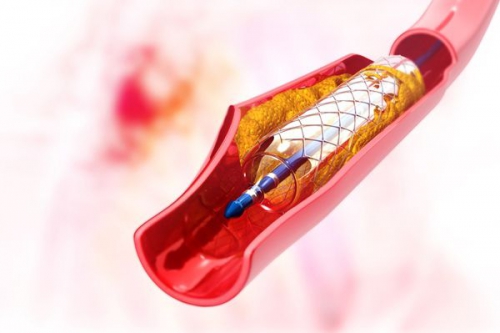 Chuyên gia giải đáp: Người đặt stent mạch vành không nên ăn gì?