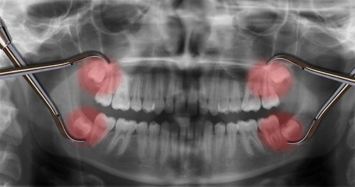 Nhổ 4 răng khôn cùng lúc có được không? Một số lưu ý cho bạn