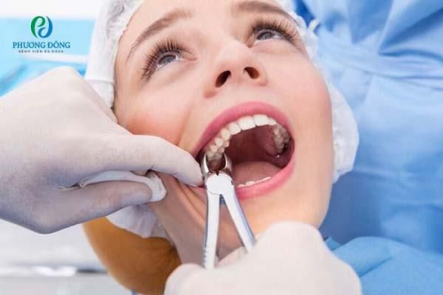 Những thông tin cần biết về nhổ răng khôn bảo hiểm y tế