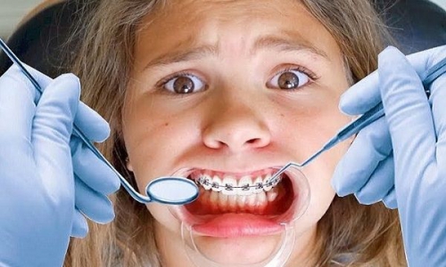 Niềng răng bị tụt lợi: Nguyên nhân và cách khắc phục