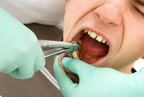 Niềng răng giai đoạn nào đau nhất? Một số lưu ý cho bạn