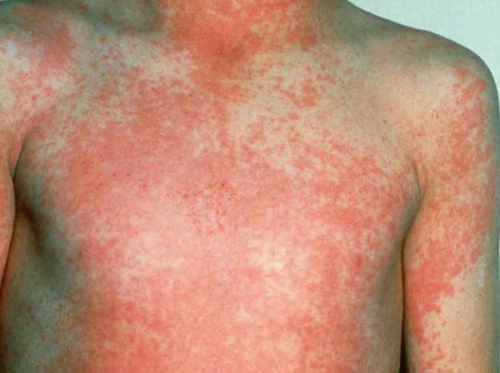 Hình ảnh sốt phát ban ở trẻ em giúp cha mẹ nhận biết