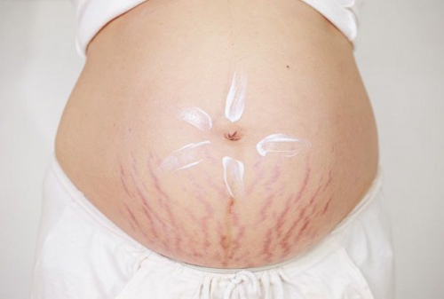 Cách khắc phục rạn da khi mang thai hiệu quả