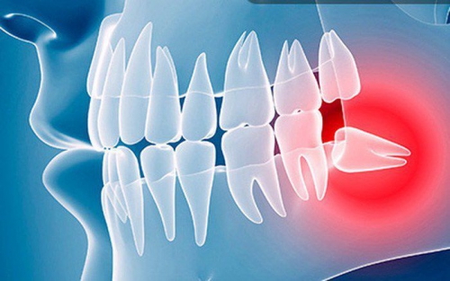 5 ảnh hưởng nghiêm trọng khi răng khôn mọc lệch 90 độ