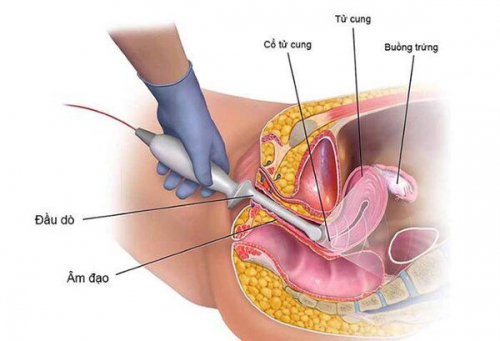 Siêu âm đầu dò thai 5 tuần có gây nguy hiểm không?