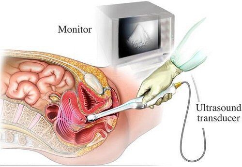Siêu âm đầu dò có vệ sinh không? Có lây bệnh không?