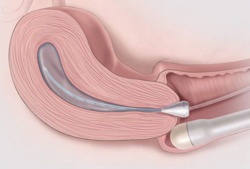 Siêu âm đầu dò bao nhiều tiền?