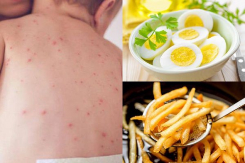 Sốt phát ban ở trẻ em cần kiêng gì? Một số lưu ý mẹ nên biết