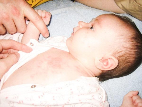 “Tất tần tật” cách chăm sóc trẻ khi bị sốt phát ban
