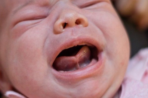 Chi phí cắt dính thắng lưỡi bao nhiêu tiền? Địa chỉ cắt dính thắng lưỡi an toàn