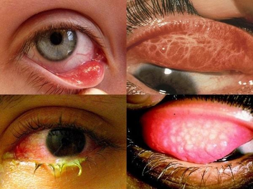 Giật mình trước “thủ phạm” làm tăng nguy cơ mắc bệnh đau mắt hột