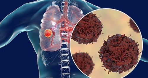 Dấu hiệu ung thư phổi giai đoạn sớm bạn cần biết