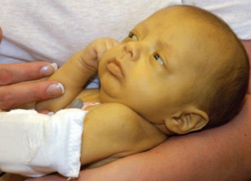 Chỉ số Bilirubin vàng da ở trẻ sơ sinh và cách điều trị