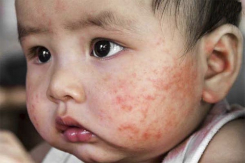 Trẻ bị viêm da cơ địa sơ sinh: Nguyên nhân và cách chăm sóc