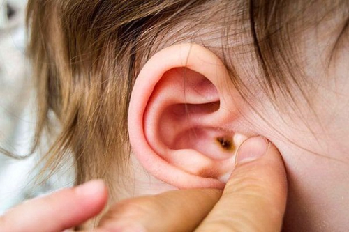 Giải đáp: Trẻ bị viêm tai giữa có tiêm phòng được không?