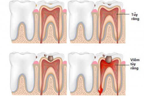 Viêm tủy răng: Phân loại, nguyên nhân và cách điều trị tránh biến chứng nguy hiểm