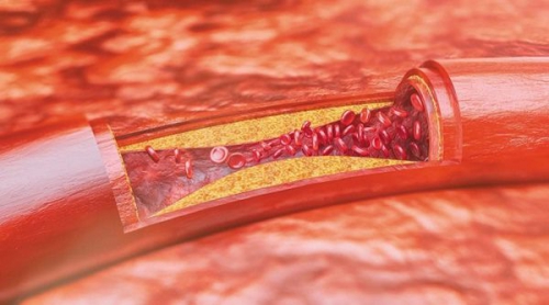 Xơ vữa động mạch cảnh có nguy hiểm không và cách điều trị