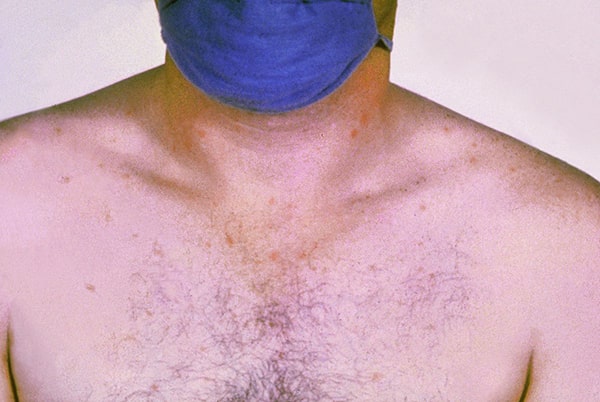 Triệu chứng nổi ban đỏ ở vùng ngực, mạn sườn, bụng của bệnh thương hàn