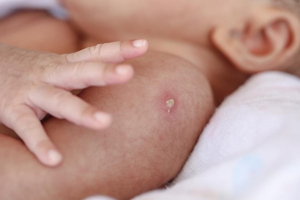 Trẻ sau khi tiêm vắc xin phòng lao thường bị sưng đỏ, mưng mủ tại vị trí tiêm