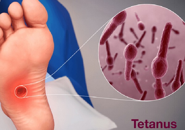 Bệnh uốn ván do ngoại độc tố Tetanus exotoxin có trong vi khuẩn Clostridium tetani gây ra