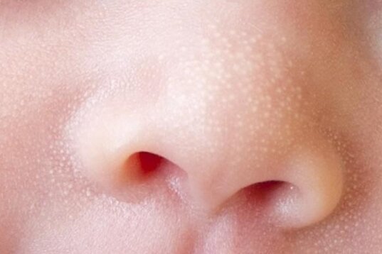 Mụn sữa ở trẻ sơ sinh có thể do hormone chuyển từ mẹ sang con