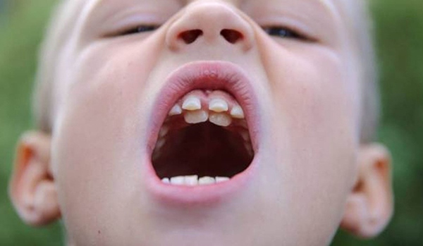 Hình ảnh trẻ có hàm răng đôi do răng sữa mọc chậm