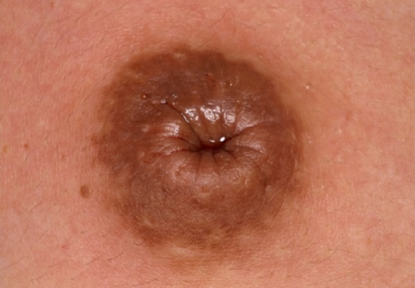 Tụt núm vú kèm hiện tượng chảu dịch bất thường là dấu hiệu cảnh báo bệnh ung thư vú