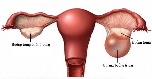 Sự khác biệt giữa buồng trứng bình thường và buồng trứng bị u nang