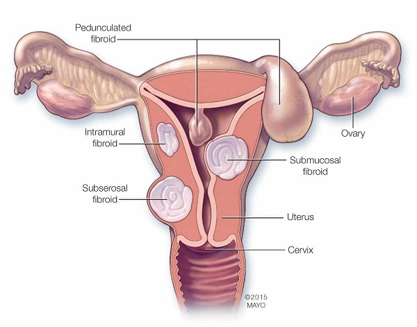 U xơ cổ tử cung là những khối u cơ có thể phát triển trên tử cung phụ nữ.