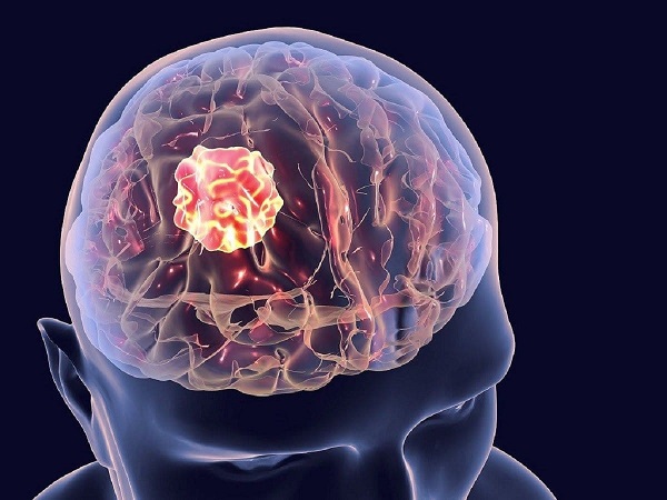 Nguyên nhân, triệu chứng và phương pháp điều trị ung thư não