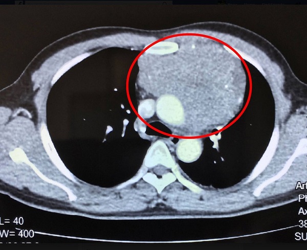 Chụp CT scanner lồng ngực chẩn đoán ung thư phổi